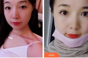 廣西來(lái)賓愛(ài)爾眼科醫(yī)院肖瀟整形價(jià)格表附眼部綜合案例展示