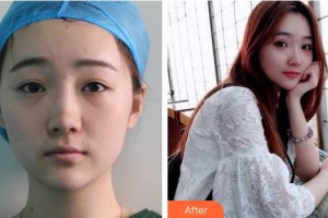 廣西廣麗醫(yī)療美容醫(yī)院劉明整形價(jià)格表附定點(diǎn)雙眼皮案例展示