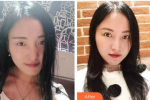 廣西來(lái)賓愛(ài)爾眼科醫(yī)院梁玉耕整形價(jià)格表附眼部綜合案例展示