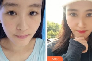 廣西來(lái)賓愛(ài)爾眼科醫(yī)院謝耀元整形價(jià)格表附切開(kāi)雙眼皮案例展示