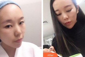 廣西來(lái)賓愛(ài)爾眼科醫(yī)院伍偉峰整形價(jià)格表附眼部綜合案例展示