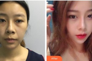 廣西東方整形美容醫(yī)院覃新月整形價(jià)格表附激光去眼袋案例展示