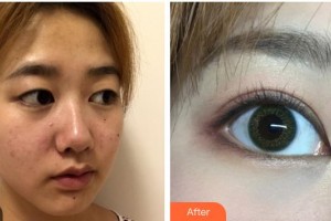 柳州愛(ài)爾眼科醫(yī)院黃俊豪整形價(jià)格表附眼部綜合案例展示