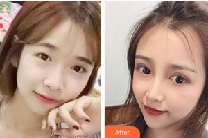 柳州紅十字會眼科醫(yī)院榮德彥整形價格表附切開雙眼皮案例展示