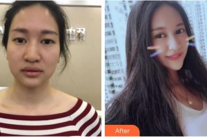 柳州紅十字會眼科醫(yī)院韋樂強整形價格表附切開雙眼皮案例展示