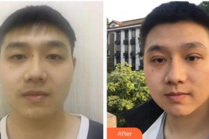 柳州紅十字會(huì)眼科醫(yī)院王歡燕整形價(jià)格表附切開(kāi)雙眼皮案例展示