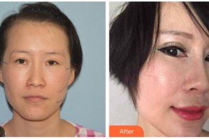 柳州紅十字會(huì)眼科醫(yī)院鄧秋瓊整形價(jià)格表附切開(kāi)雙眼皮案例展示