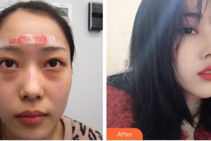 柳州愛爾眼科醫(yī)院王冬梅整形價格表附眼部修復(fù)案例展示