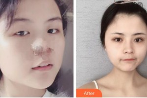 柳州市人民醫(yī)院眼科張曉湄整形價格表附切開雙眼皮案例展示