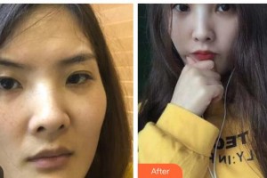 桂林醫(yī)學(xué)院第二附屬醫(yī)院眼科許行艷整形價格表附切開雙眼皮案例展示