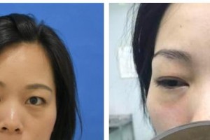 桂林醫(yī)學(xué)院第二附屬醫(yī)院眼科王莉整形價格表附激光去眼袋案例展示