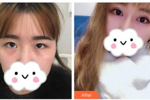 桂林市人民醫(yī)院眼科錢錦芳整形價(jià)格表附眼部綜合案例展示