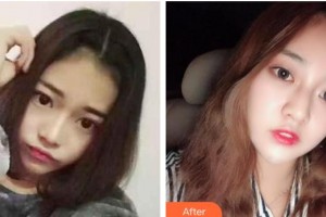 桂林市人民醫(yī)院眼科徐鶯歌整形價格表附埋線雙眼皮案例展示