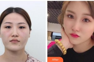 桂林市人民醫(yī)院眼科廖偉整形價格表附切開雙眼皮案例展示