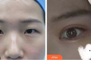 桂林市人民醫(yī)院眼科李柏堅整形價格表附眼部綜合案例展示