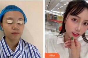 桂林市人民醫(yī)院眼科鐘旭整形價格表附眼部綜合案例展示