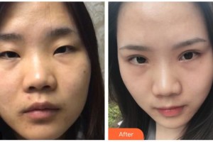 梧州市工人醫(yī)院眼科陸華文整形價(jià)格表附切開雙眼皮案例展示