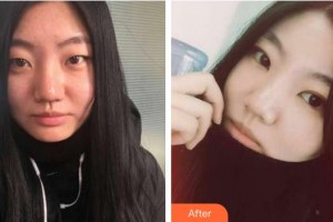 梧州市工人醫(yī)院眼科楊勝信整形價(jià)格表附埋線雙眼皮案例展示