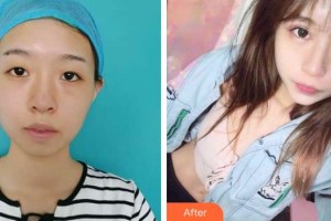 梧州市工人醫(yī)院眼科趙海金整形價(jià)格表附眼部綜合案例展示