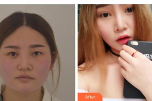 梧州市工人醫(yī)院眼科賀瑋整形價(jià)格表附切開雙眼皮案例展示