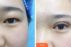 梧州市工人醫(yī)院眼科楊俊整形價(jià)格表附切開雙眼皮案例展示