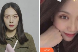 貴港愛爾眼科醫(yī)院梁岸整形價(jià)格表附眼部綜合案例展示