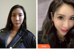 貴港愛爾眼科醫(yī)院潘可生整形價(jià)格表附切開雙眼皮案例展示