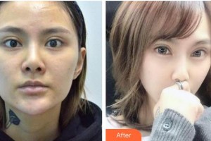 玉林愛爾眼科醫(yī)院周平整形價(jià)格表附眼部綜合案例展示