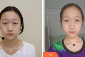 玉林時(shí)光醫(yī)療美容醫(yī)院陳鴻整形價(jià)格表附切開雙眼皮案例展示