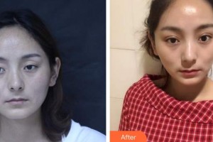 來賓市人民醫(yī)院眼科吳佳勢(shì)整形價(jià)格表附切開雙眼皮案例展示