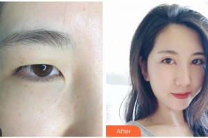 來賓市人民醫(yī)院眼科陳燕玲整形價(jià)格表附眼部綜合案例展示