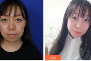 來賓市人民醫(yī)院眼科譚揚(yáng)勇整形價(jià)格表附眼部綜合案例展示