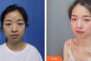 來賓市人民醫(yī)院眼科何發(fā)堅(jiān)整形價(jià)格表附眼部綜合案例展示