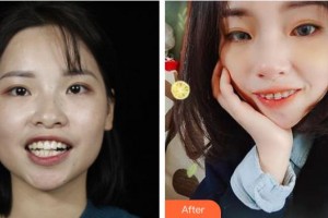 江陰東方女子醫(yī)院整形美容中心袁宇剛整形價格表附金屬托槽矯正案例展示