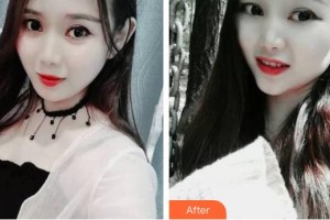 江陰艾爾美醫(yī)療美容診所李亨教整形價格表附牙齒隱形矯正案例展示