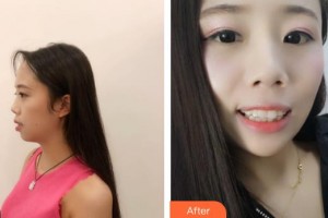 江陰牙博士口腔門診部顧冬輝整形價格表附牙齒隱形矯正案例展示