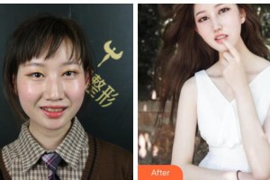 江陰光明眼科醫(yī)院朱建剛整形價格表附牙齒隱形矯正案例展示