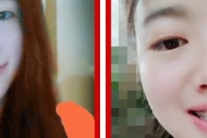 江陰牙博士口腔門診部張磊整形價格表附金屬托槽矯正案例展示