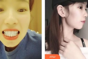 江陰艾爾美醫(yī)療美容診所張思平整形價格表附牙齒隱形矯正案例展示