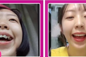 江陰牙博士口腔門診部于庭波整形價格表附金屬托槽矯正案例展示