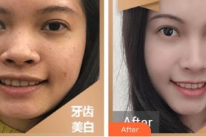 江陰牙博士口腔門診部劉曉瑋整形價格表附冷光美白案例展示