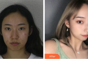 江陰光明眼科醫(yī)院卞春及整形價格表附切開雙眼皮案例展示