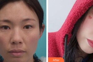 江陰艾爾美醫(yī)療美容診所吳聃整形價格表附切開雙眼皮案例展示