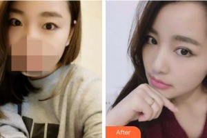 江陰市人民醫(yī)院整形美容科陳一松整形價格表附切開雙眼皮案例展示