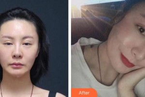 江陰艾爾美醫(yī)療美容診所元琦晸整形價格表附眼部修復案例展示