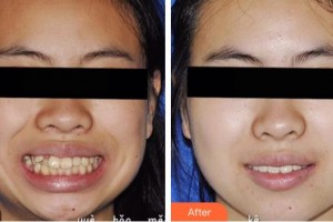 江陰牙博士口腔門診部李乃晨整形價格表附隱形托槽矯正案例展示