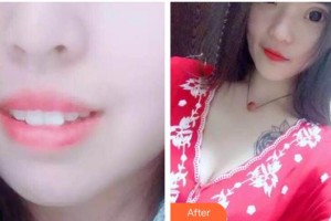 江陰牙博士口腔門診部張瑞杰整形價格表附牙齒隱形矯正案例展示