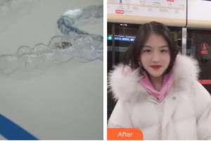 江陰牙博士口腔門診部林曉整形價格表附牙齒隱形矯正案例展示