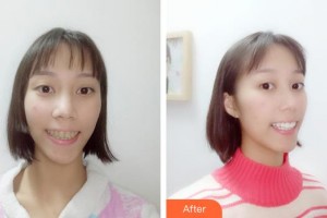 江陰牙博士口腔門診部關鑫整形價格表附超聲波潔牙案例展示