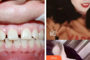 江陰金誠口腔門診部張曉瑩整形價格表附牙齒隱形矯正案例展示